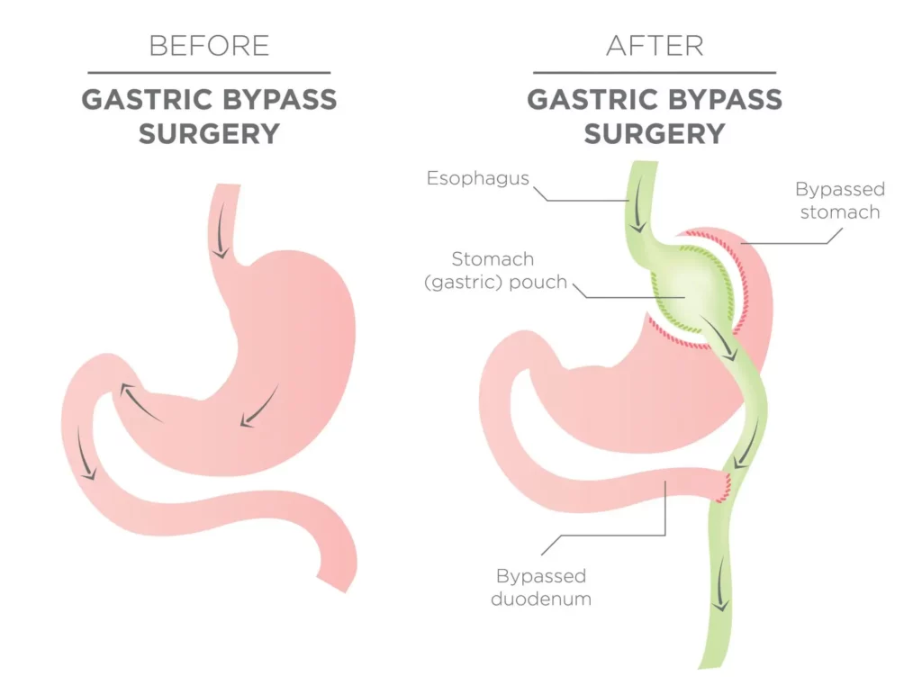 Laparoscopische Gastric Bypass